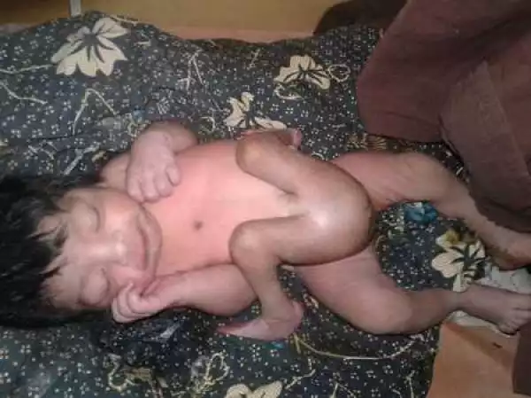 Omg! Baby Boy Born With 4 Legs and Two Male S*x Organs Undergoes Crucial Operation (Photos)